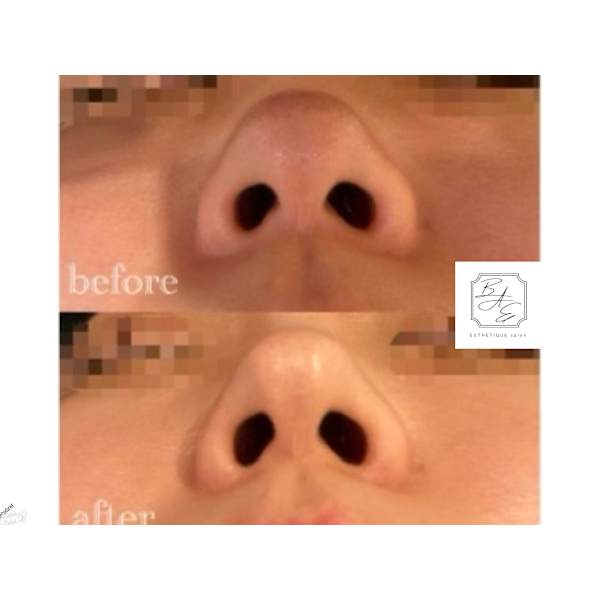 ロングヒット☆鼻縮小【単品】