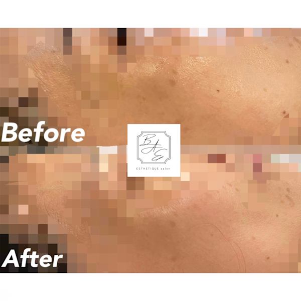 赤みシミ撃退☆E－rightフォトフェイシャル