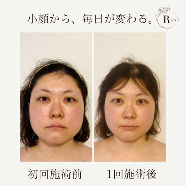 【迷ったらこれ/リフトアップ＆くすみオフ肌】シャープフェイス小顔矯正＋ミネラルクレイパック