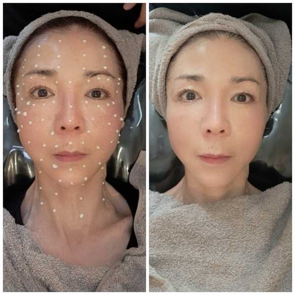 最最最新のダイヤモンド🔯特別ケア⭐︎水光肌&毛穴&ハリ&美白などノーメイクで過ごす肌作りに