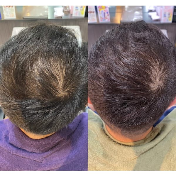 極上！生え際、つむじまわり…気にしている方必見【グローザヘアーコース】￥21000→初回￥16500