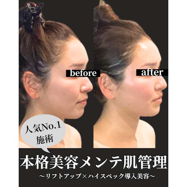 ◆人気No.1◆【本格メンテ肌管理】リフトアップ×ツヤ肌　　120分　¥29,000→