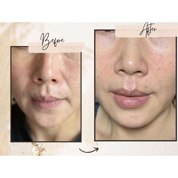 【たるみ・くすみ改善】歳が感じない　プラチナケア￥15000→￥9900