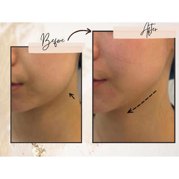 【二重あご】医療提携の顔全面脂肪減量小顔ケア￥15000→¥9900