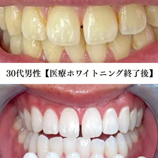 ワンランク上の白さを実現プレミアムホワイトニング￥4,980