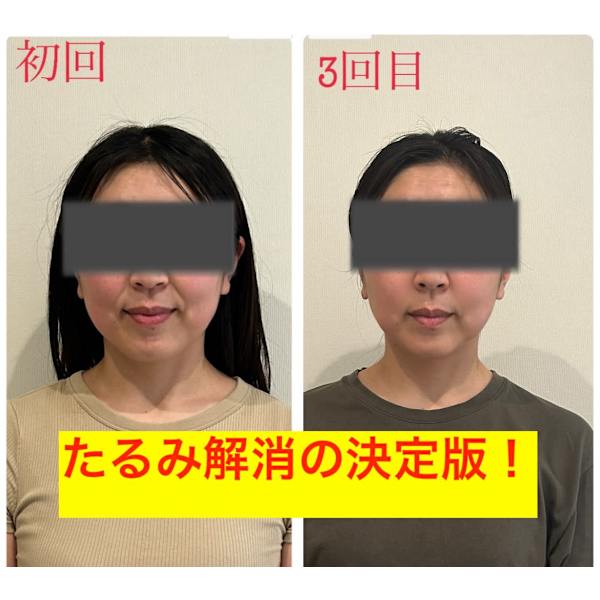 ★ほうれい線＆鼻下からのたるみ肉改善ケア★もったりアゴ肉・頬のたるみにも◎