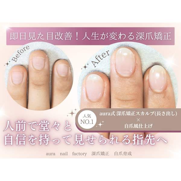《即日見た目改善》aura式☆深爪矯正スカルプ(長さ出し)《自爪風仕上げ》［赤羽］