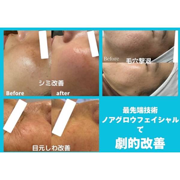 ◎シミ・しわケアー『月一回のリフトアップ』に最適