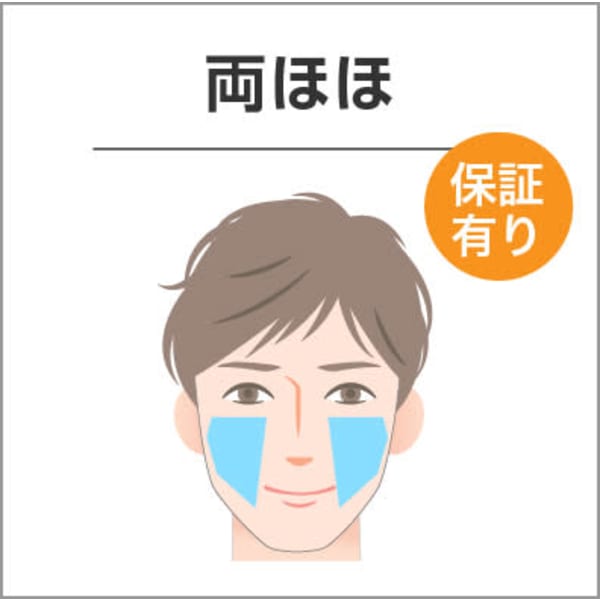 部分ヒゲ脱毛 両ほほ