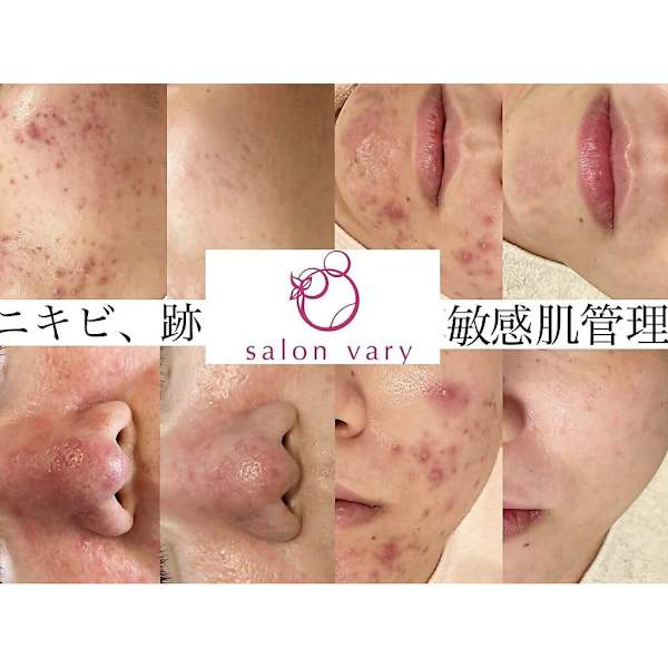 メニューに悩む方へ。【肌診断&カウンセリング】