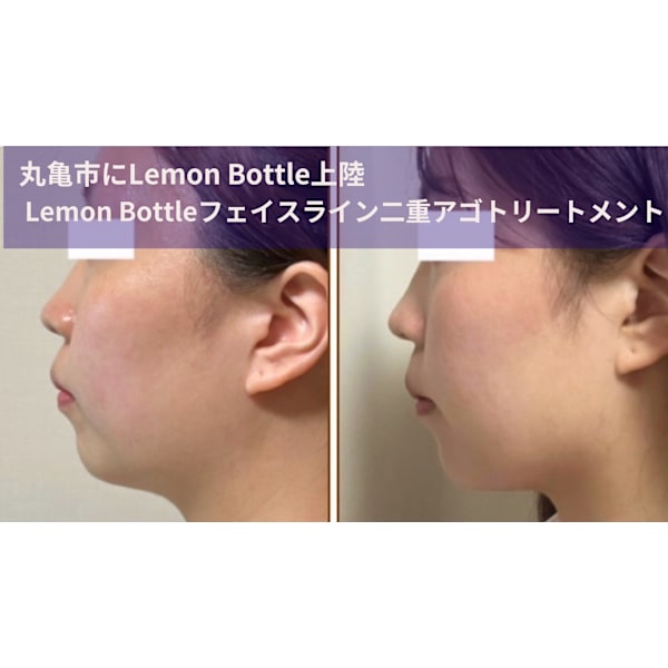 【小顔を目指す】丸亀市上陸!レモンボトルフェイスライン・二重アゴスッキリ特別価格¥9,900