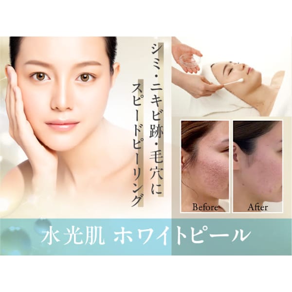 『白雪肌ホワイトスノーピール』乳酸ピーリングで集中美白体験¥13200→￥5500