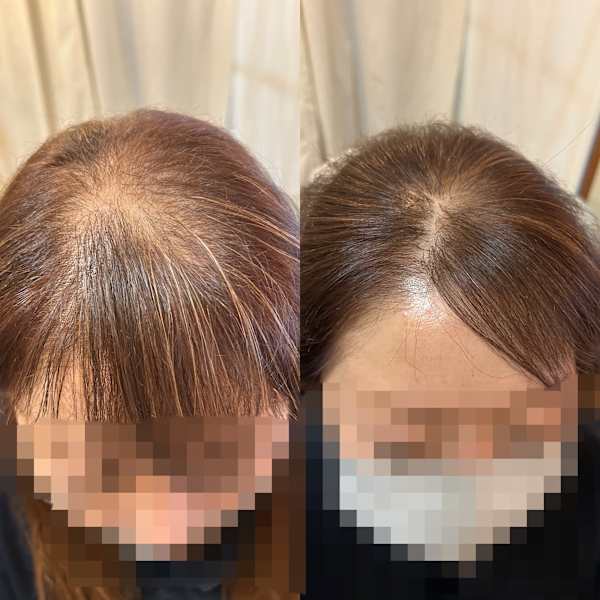 ふんわりボリューム増毛ヘアエクステ無料カウンセリング