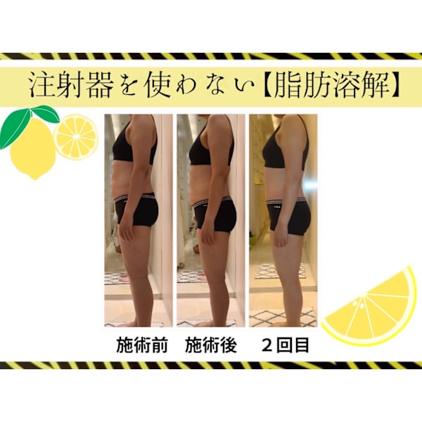 【史上最高の痩せBODY】レモンボトル6cc導入×キャビ体験25300円→11000円