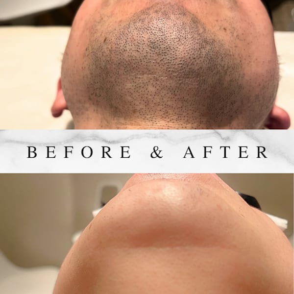 ひげ全部☆2回お試しコース ひげを剃らなくてもいい毎日への第1歩!