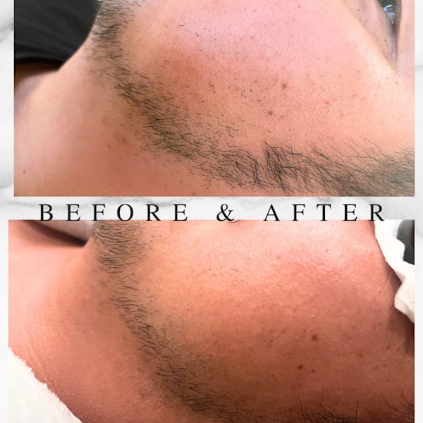 ひげ部分脱毛☆2回お試しコース まずは1か所からお気軽に♪無精ひげからおしゃれひげへ!