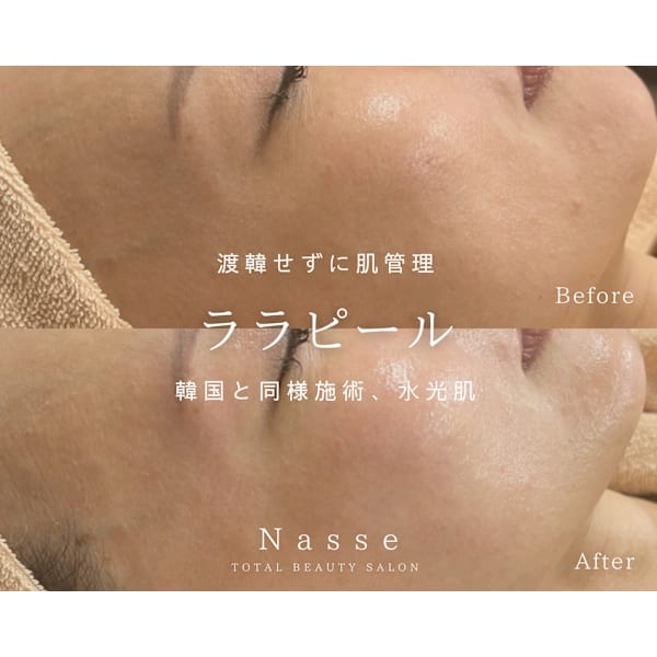 【韓国肌管理/毛穴/艶肌】ララピール（首込み）￥9800