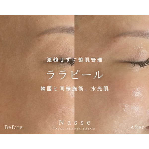 渡韓しなくても叶う艶肌管理☆ララピール＋専用ゲルパック＋ポレーション付