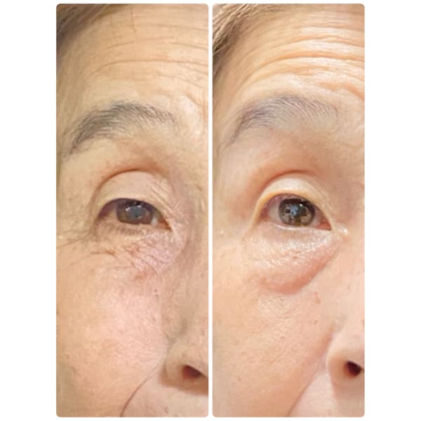 【目のまぶたが重い・開けにくい方フェイシャル】顔と目の周りの筋肉を柔軟+小顔+シミシワたるみ改善!