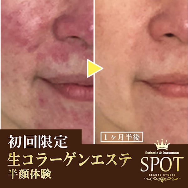 【初回限定50％off】特許成分フェース生コラーゲン全顔仕上げ◆5,500円　11,000円→