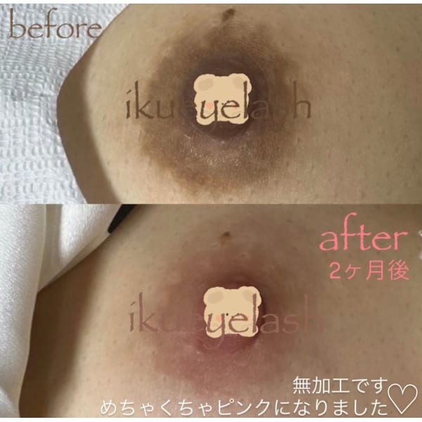 オープン記念20%オフ⭐️乳輪.乳頭×ラニンケア※外陰部.脇.膝.箇所&メンズ相談