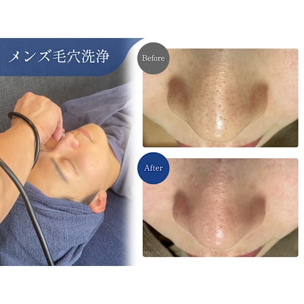 【初めての方にオススメ】★SNSで話題の肌診断+小鼻の黒ずみ洗浄 ¥1980