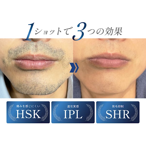 【メンズ脱毛】ヒゲ全体脱毛★980円体験!迷ったらまず予約が◎