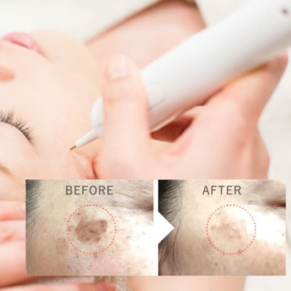 【10周年キャンペーン】シミ改善ポイントケア☆どこでも10分　¥3300→2800