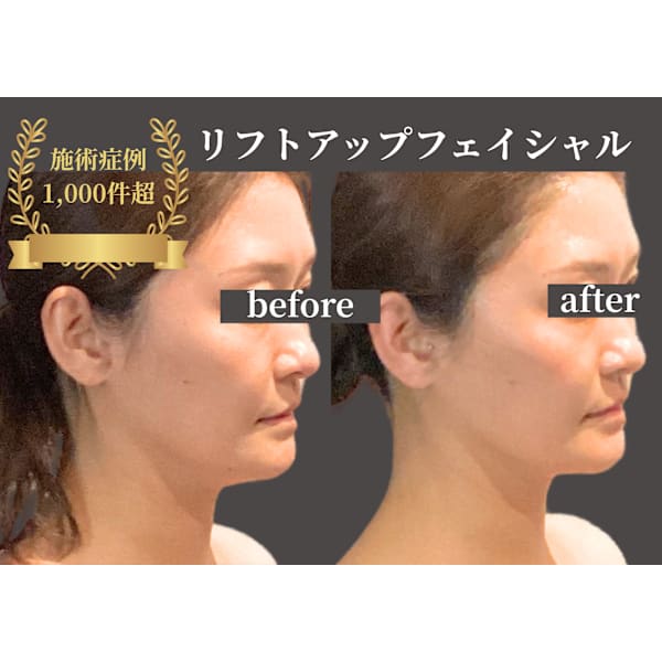 ◆症例数1,000件超◆リフトアップフェイシャル　顔＆ヘッド＆デコルテ　90分　¥19,800