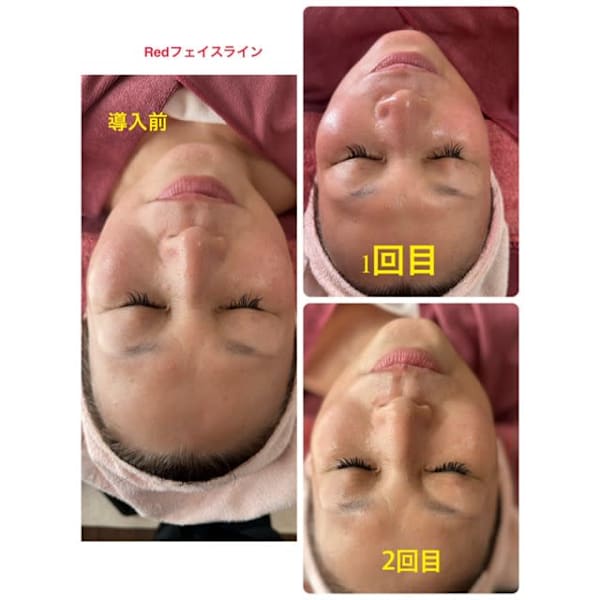 新導入☆エステできらない小顔ケア　脂肪溶解⁺美容液導入　フェイスラインすっきり　小顔効果絶大！