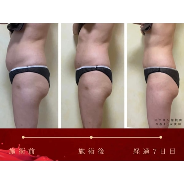 塗るだけの脂肪溶解Redshot！気になるお腹、二の腕に集中アプローチ☆理想のボディメイクを加速☆