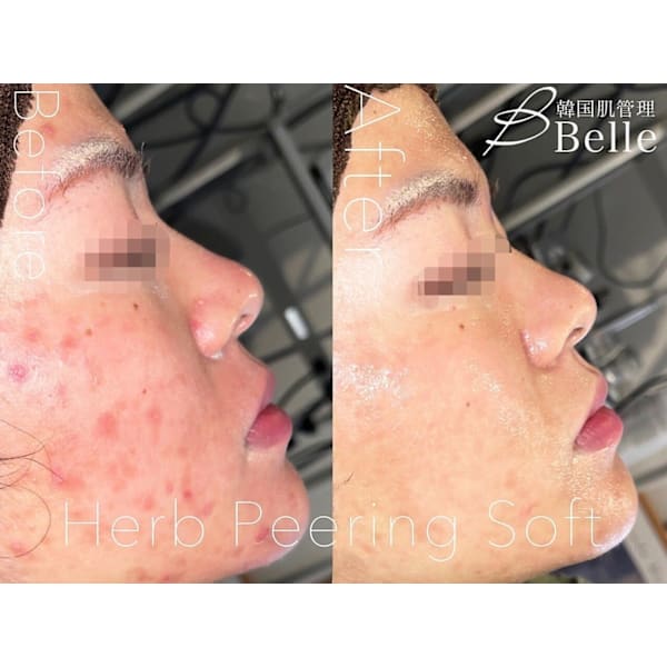 【初回限定基本のケア】韓国肌管理☆剥離無しハーブピーリング￥6,000