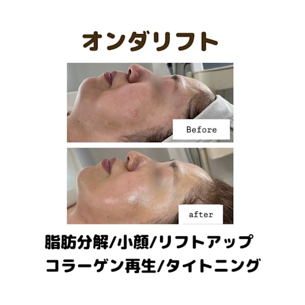 《モニター価格》韓国発脂肪溶解×リフトアップ　マイクロ波リフト39800円→15800円