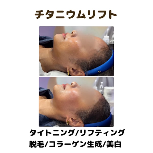 《モニター価格》韓国発チタニウムリフト　39800円→15800円