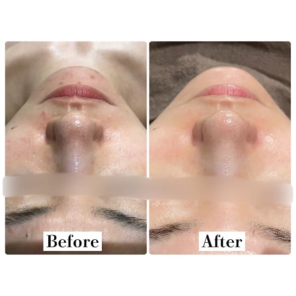 人気No.1肌質改善《塗る糸リフト美容液導入付》毛穴洗浄ハイドロfacial ¥9900