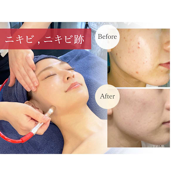 【治りが遅い大人の頑固なニキビケア】AI肌診断+ダイヤモンドピーリング+クールビタミン導入
