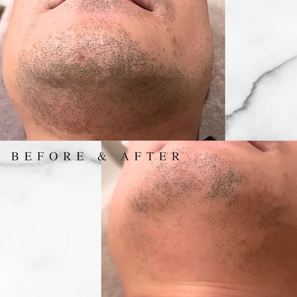 ひげ全部☆2回お試しコース【２回目】　１度目の期待が確信に変わる２回目！