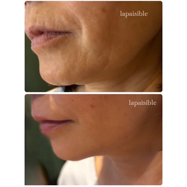 RED　SHOT輪郭形成スペシャル導入…脂肪分解パイナップル成分が脂肪層まで届きお顔ラインに働く