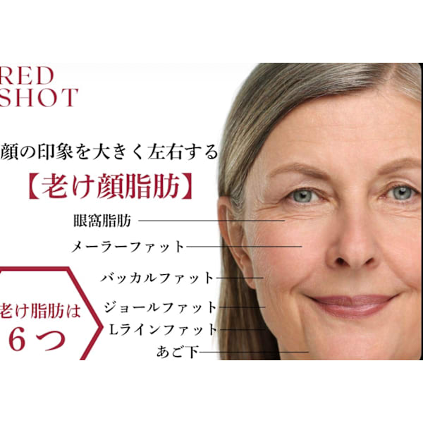 【REDショット】目の下の脂肪・たるみ・クマに徹底アプローチ