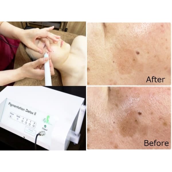 2回目【シミケア/ピグメンテーション30分+ヒト幹細胞導入】　8800円