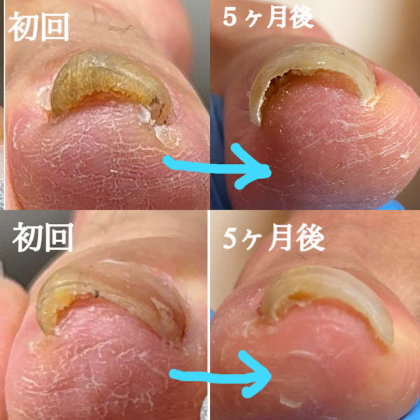 巻き爪ケア(所要時間はカウンセリング込みで、状態により異なります)