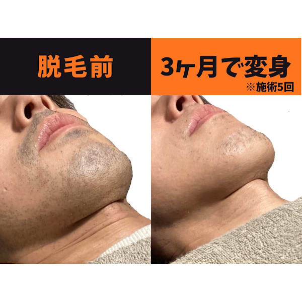 メンズ脱毛サロンmoi