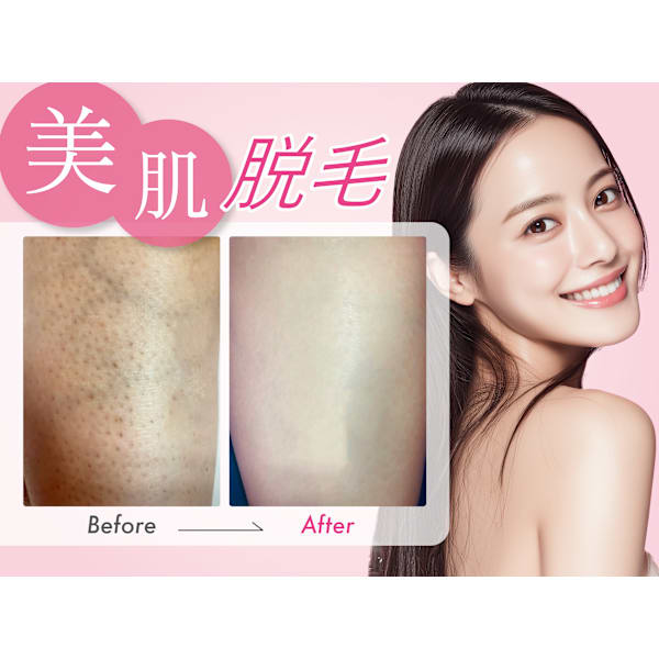 【脱毛も美肌も叶えたい方】ハイパースキン脱毛 10ヵ所体験　エステ券付き♪