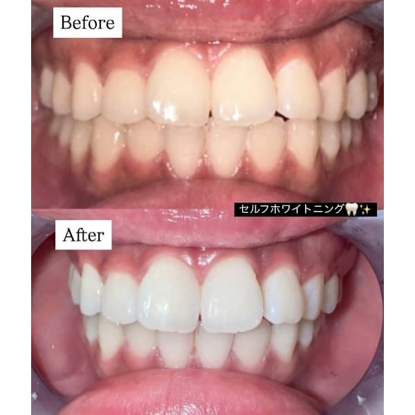 【セルフホワイトニング】セルフ界最高出力15分¥2980