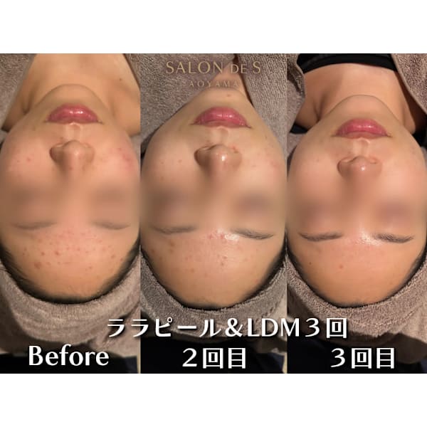 ララピール×LDM水玉リフティング|最新韓国式肌管理で毛穴レスな究極の水光肌へ導く本格ケア