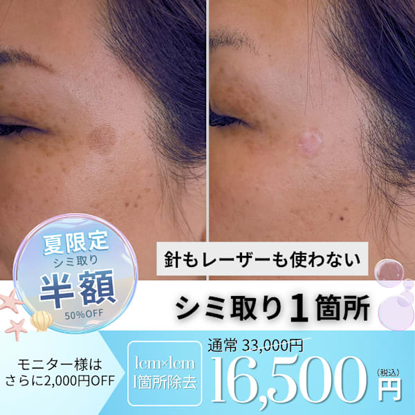 【夏限定|半額】シミ取り1箇所