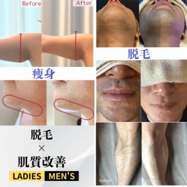 【ハーブピーリング|肌質改善】BE:SKIN広島