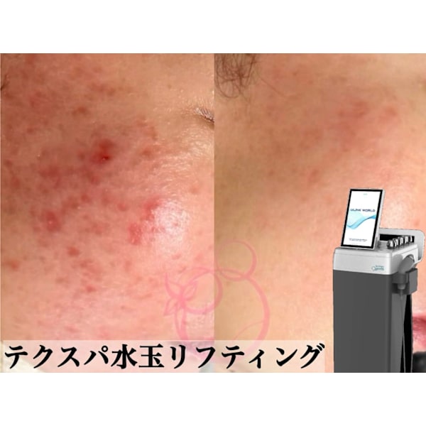 【敏感肌用水玉リフティング/酒さ/赤み】テクスパ水玉リフティング 