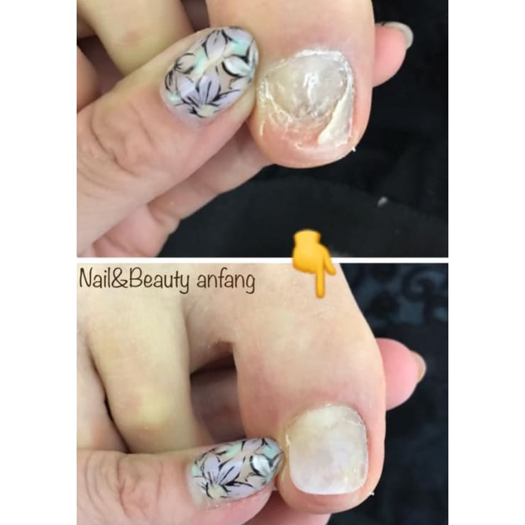 巻き爪 剥離 深爪 爪の状態に合った適切な施術をご提案します Nail Beauty Anfang ネイルアンドビューティーアンファング のこだわり特集 ネイル まつげサロンを予約するなら楽天ビューティ