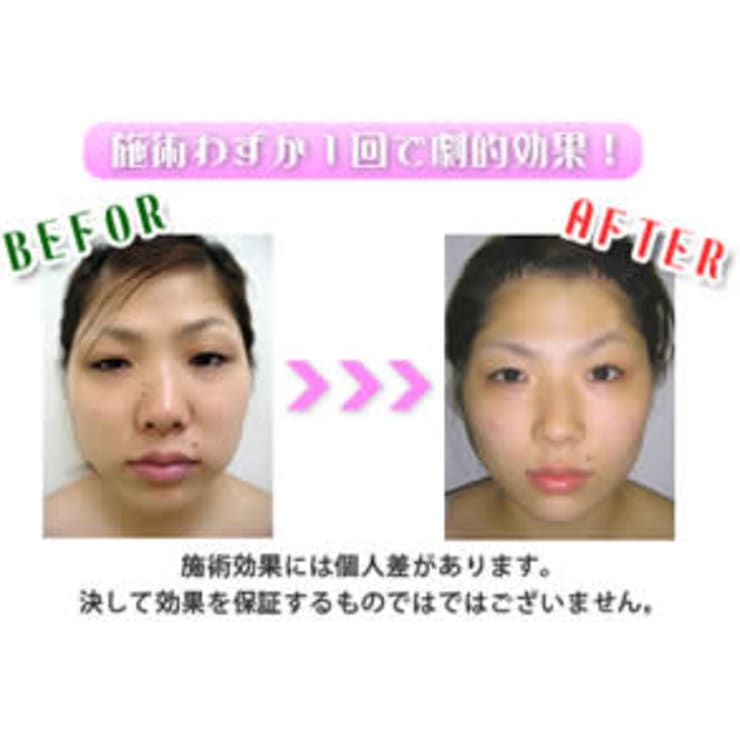 本格美小顔フェイシャル】脂肪燃焼&細胞を活性化しハリ・弾力 本格美小顔フェイシャル】脂肪燃焼&細胞を活性化しハリ・弾力